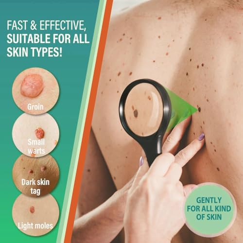 Skin-Tag-Remover-Kit, Mole & Wart-Remover Cream, Safe and Fast-Acting Tag-Removal & Verruca-Treatment - Image 4