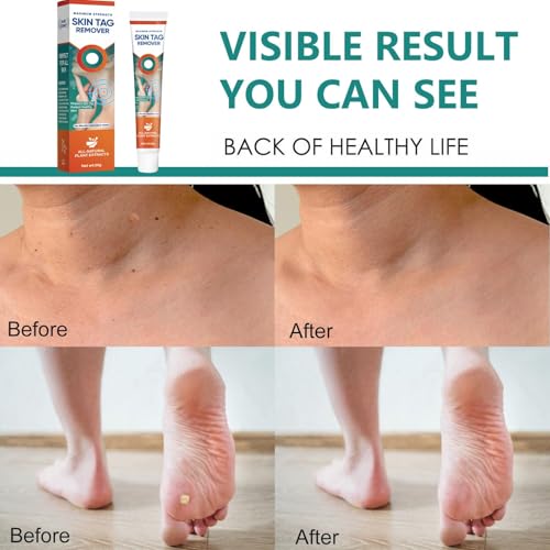 Skin-Tag-Remover-Kit, Mole & Wart-Remover Cream, Safe and Fast-Acting Tag-Removal & Verruca-Treatment - Image 6